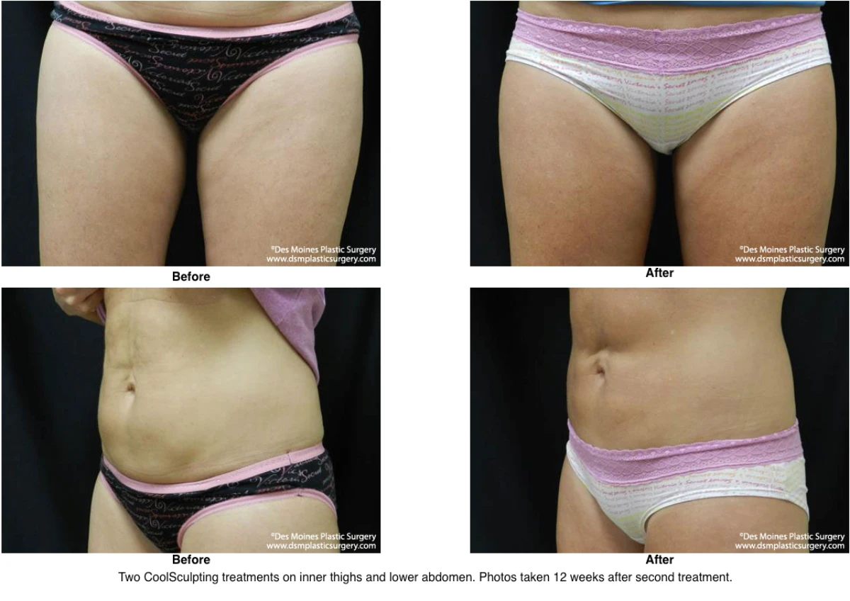 Coolsculpting Before and After Photo Performed by Dr David Robbins