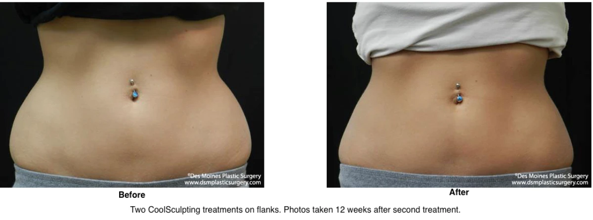 Coolsculpting Before and After Photo Performed by Dr David Robbins