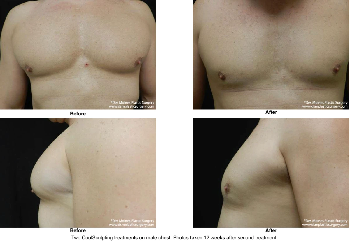 Coolsculpting Before and After Photo Performed by Dr David Robbins