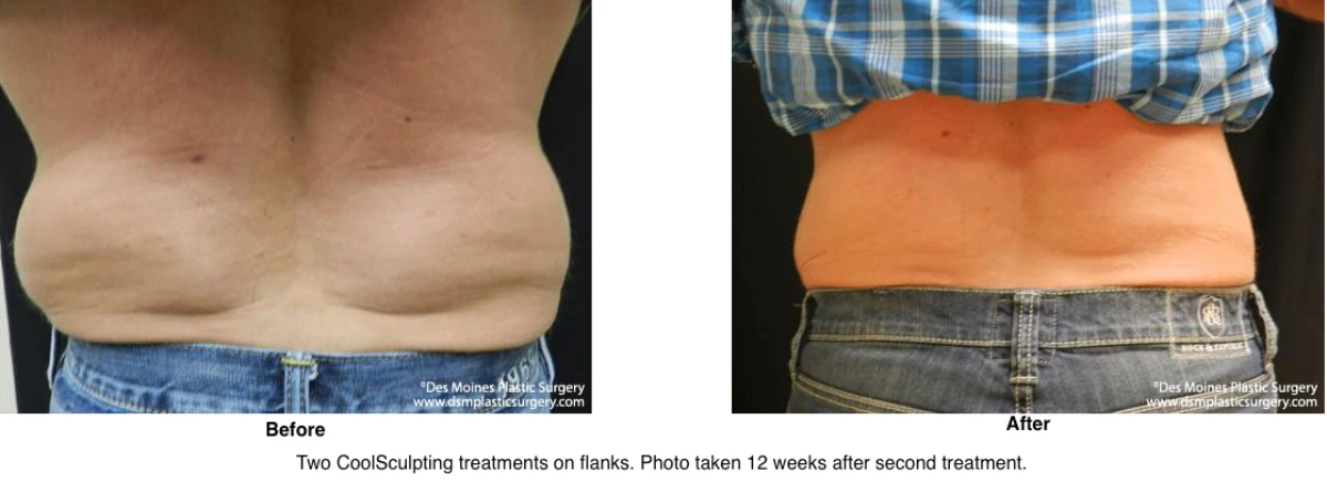 Coolsculpting Before and After Photo Performed by Dr David Robbins