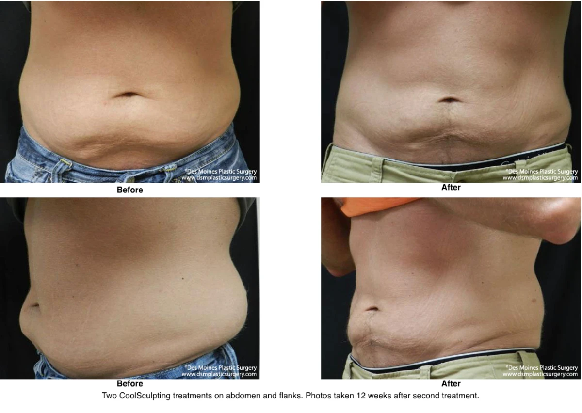 Coolsculpting Before and After Photo Performed by Dr David Robbins