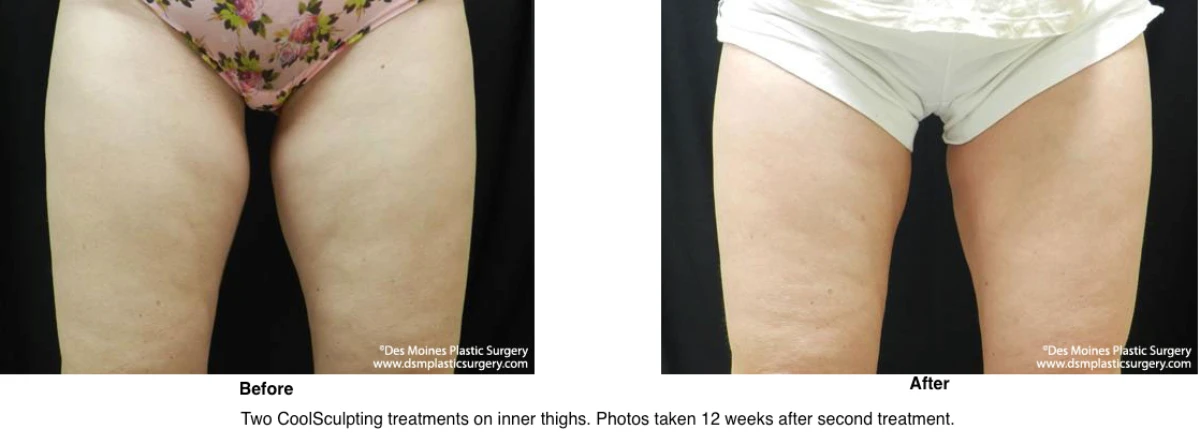 Coolsculpting Before and After Photo Performed by Dr David Robbins