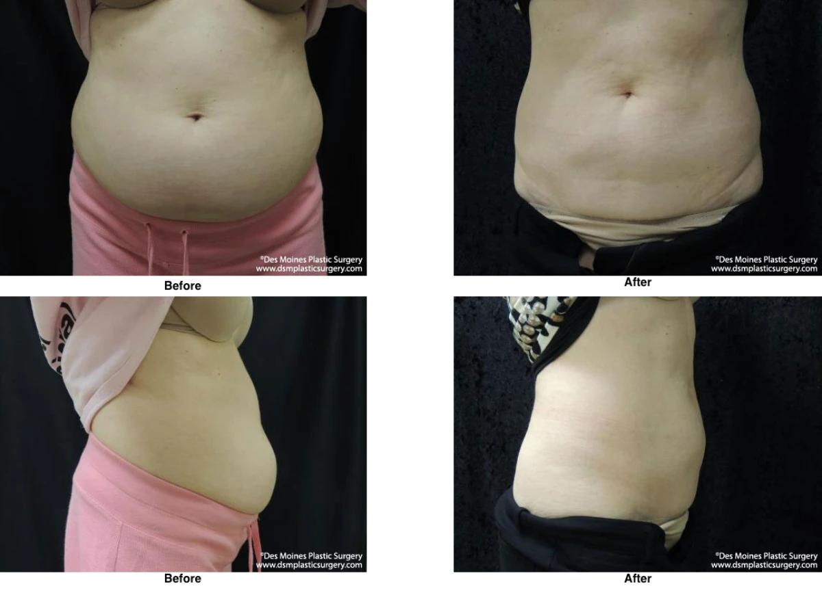 Coolsculpting Before and After Photo Performed by Dr David Robbins