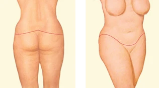 diagram showing deep sutures within the tissues that help form the new contours