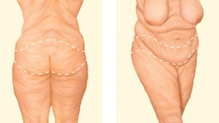 diagram showing an incision around the body removes an apron of excess skin and fat