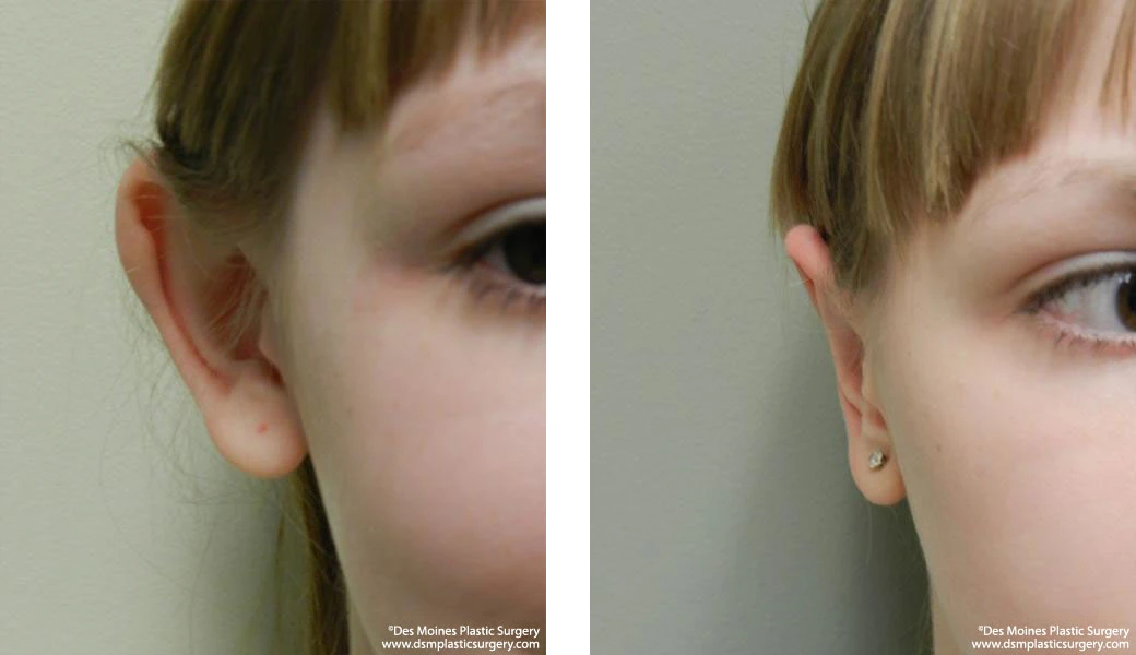 Ear Surgery Before and After Photo by Dr David Robbins