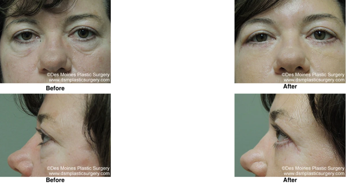 Eyelid Surgery Before and After Performed by Dr David Robbins