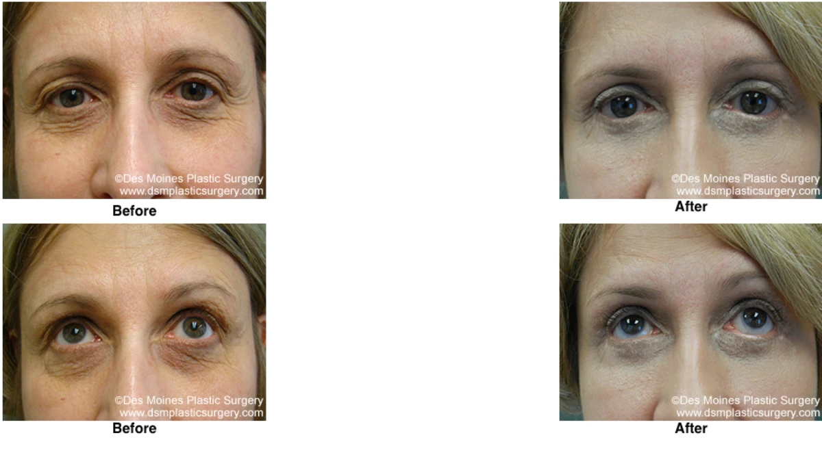 Eyelid Surgery Before and After Performed by Dr David Robbins