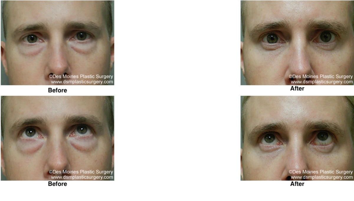 Eyelid Surgery Before and After Performed by Dr David Robbins