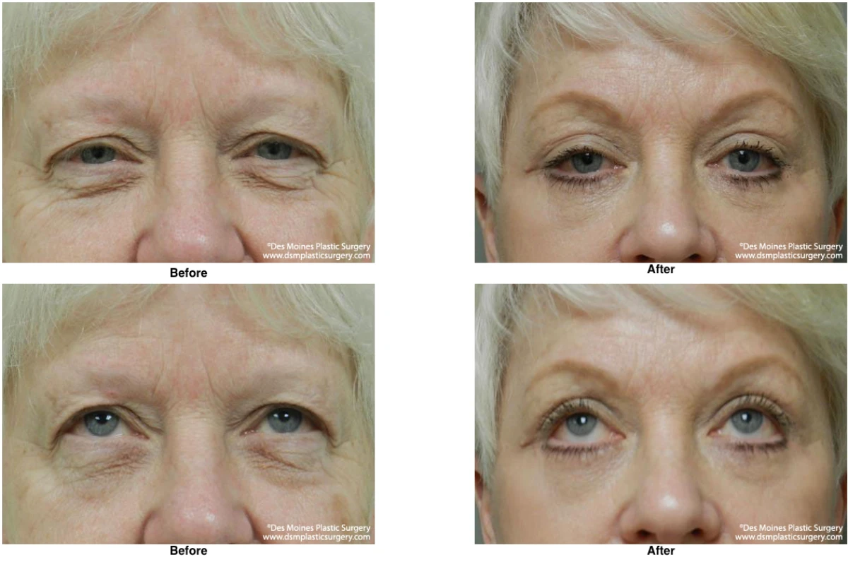 Eyelid Surgery Before and After Performed by Dr David Robbins