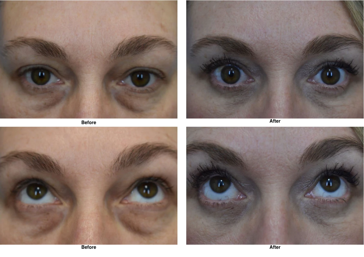 Eyelid Surgery Before and After Performed by Dr David Robbins