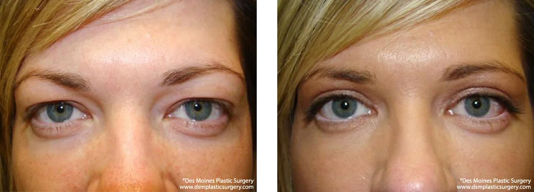 Eyelid Surgery Before and After Photo Performed by Dr David Robbins