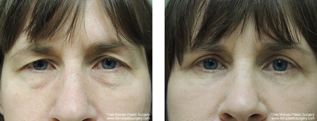 Eyelid Surgery Before and After Photo Performed by Dr David Robbins