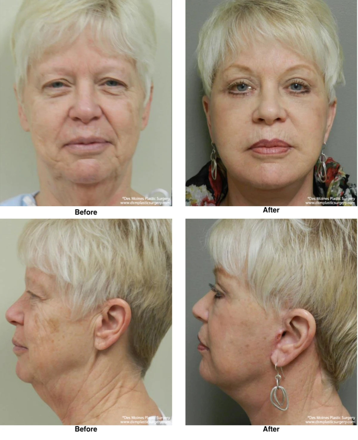 Facelift Before and After Photo by Dr David Robbins