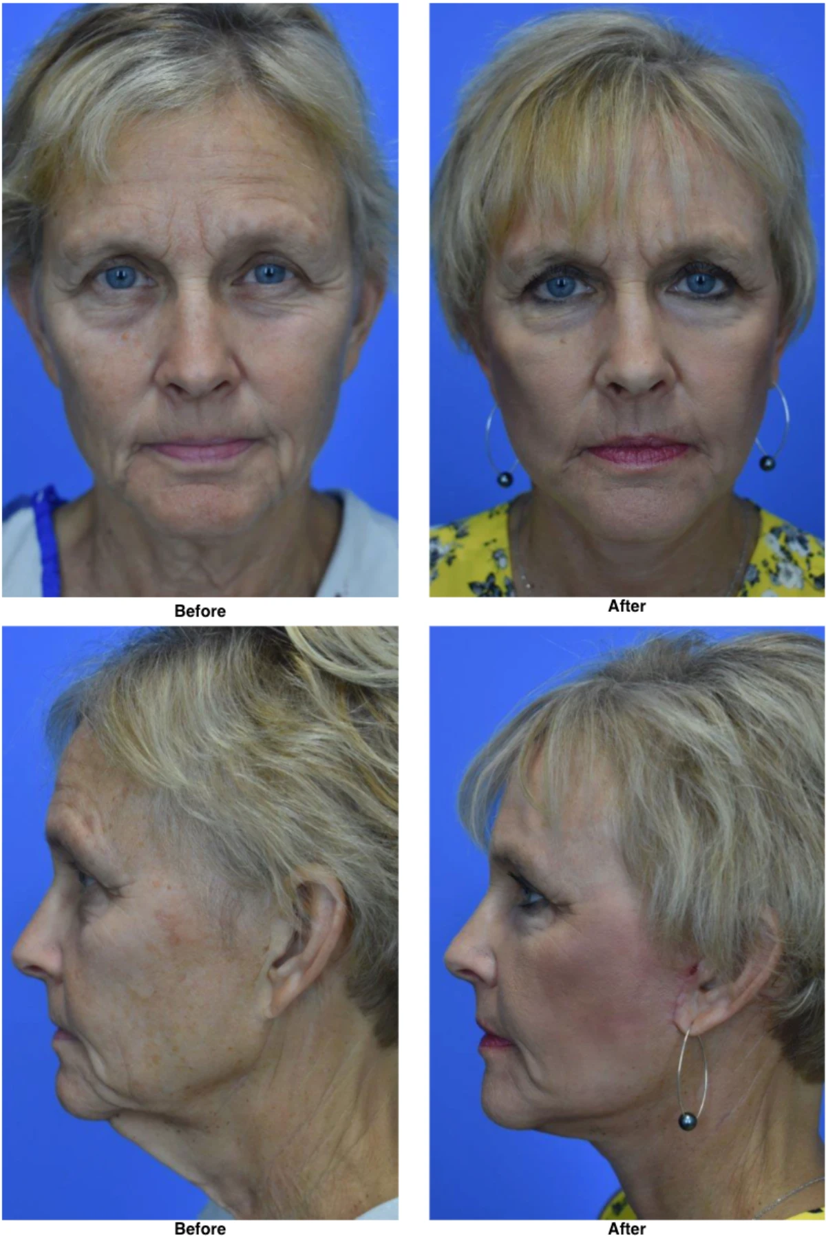 Facelift Before and After Photo by Dr David Robbins