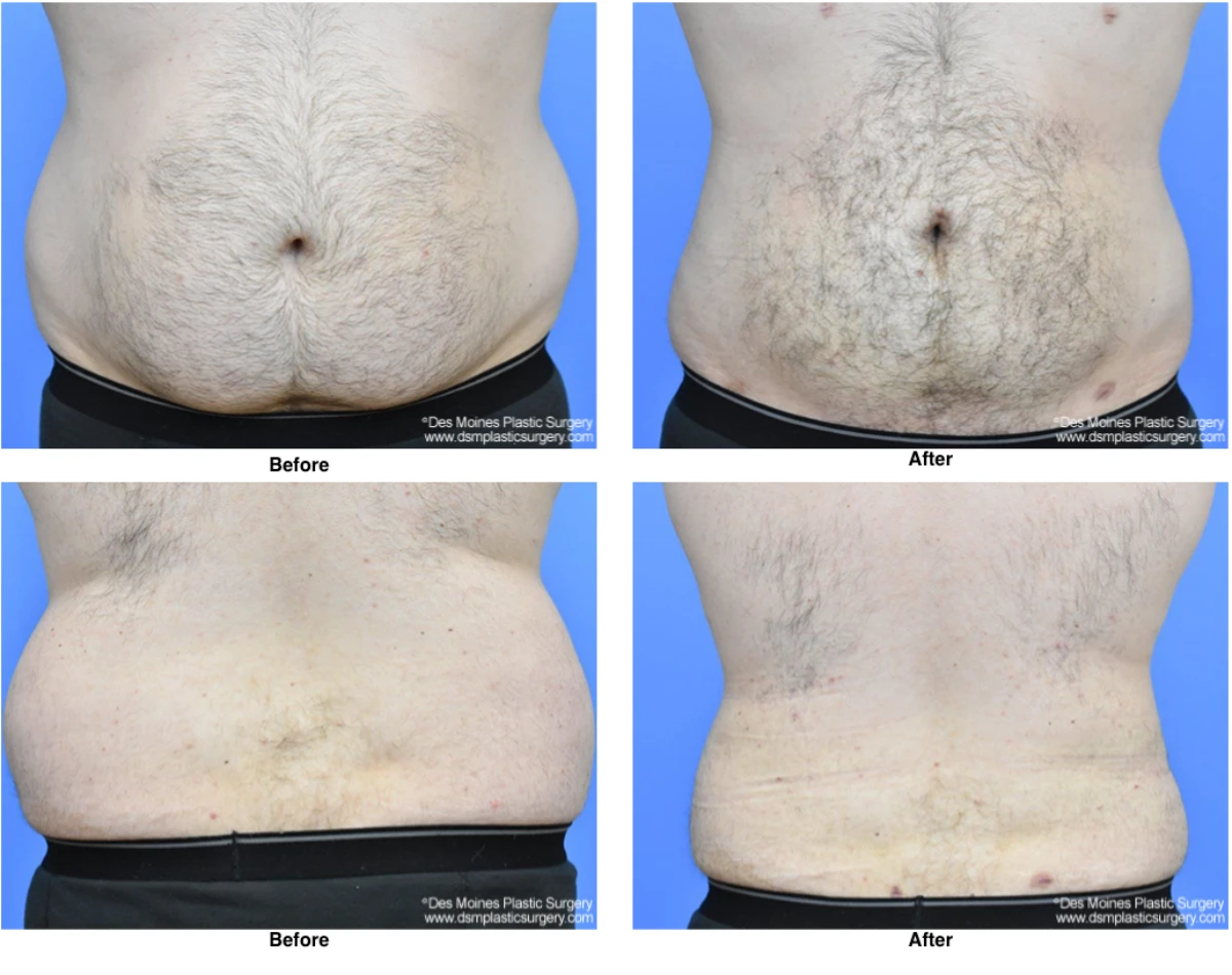 Liposuction Before and After Performed by Dr David Robbins