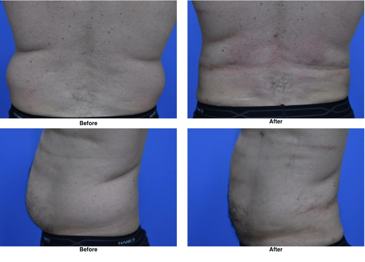 Liposuction Before and After Performed by Dr David Robbins