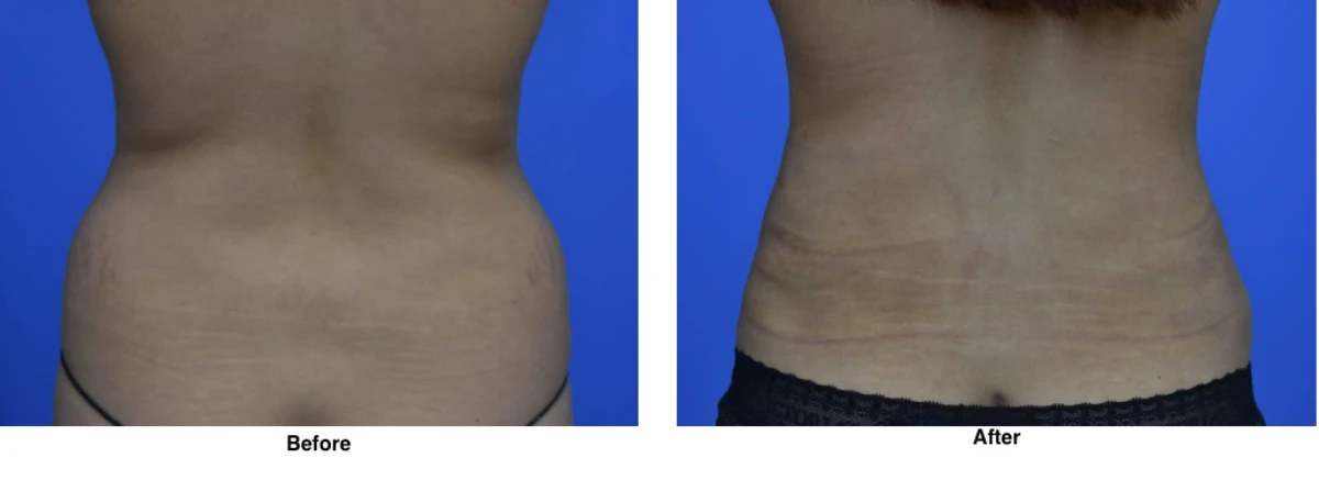 Liposuction Before and After Performed by Dr David Robbins