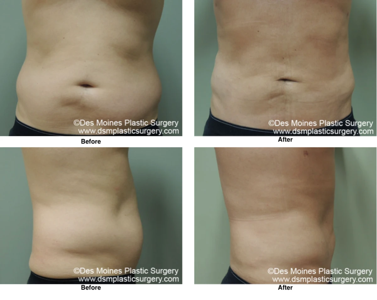 Liposuction Before and After Performed by Dr David Robbins