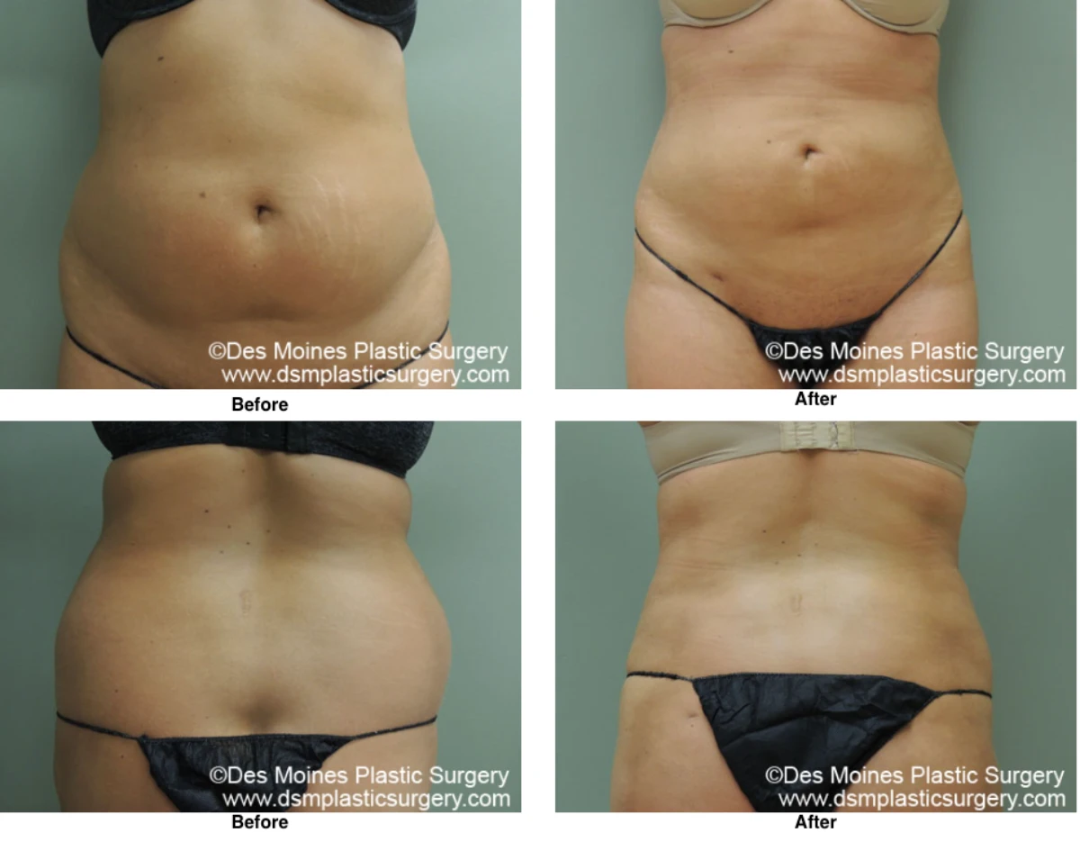 Liposuction Before and After Performed by Dr David Robbins