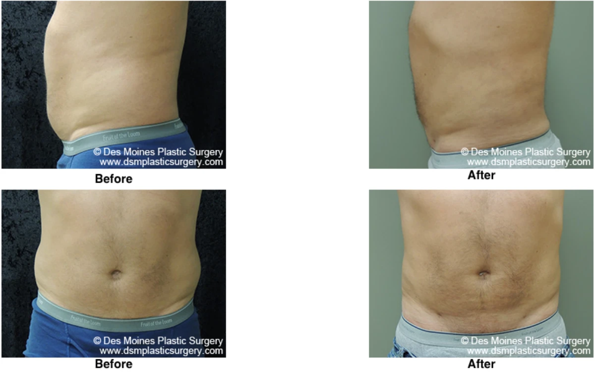 Liposuction Before and After Performed by Dr David Robbins