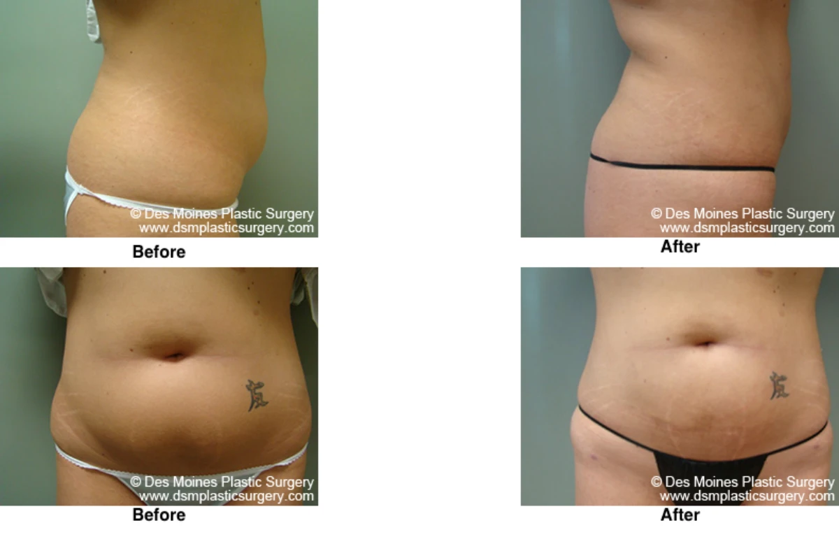 Liposuction Before and After Performed by Dr David Robbins