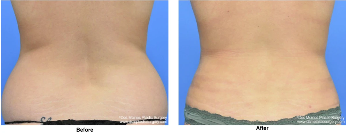 Liposuction Before and After Performed by Dr David Robbins