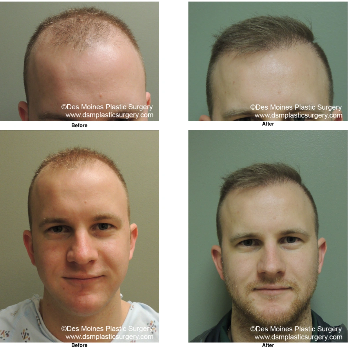 Neograft Hair Loss Replacement Before and After