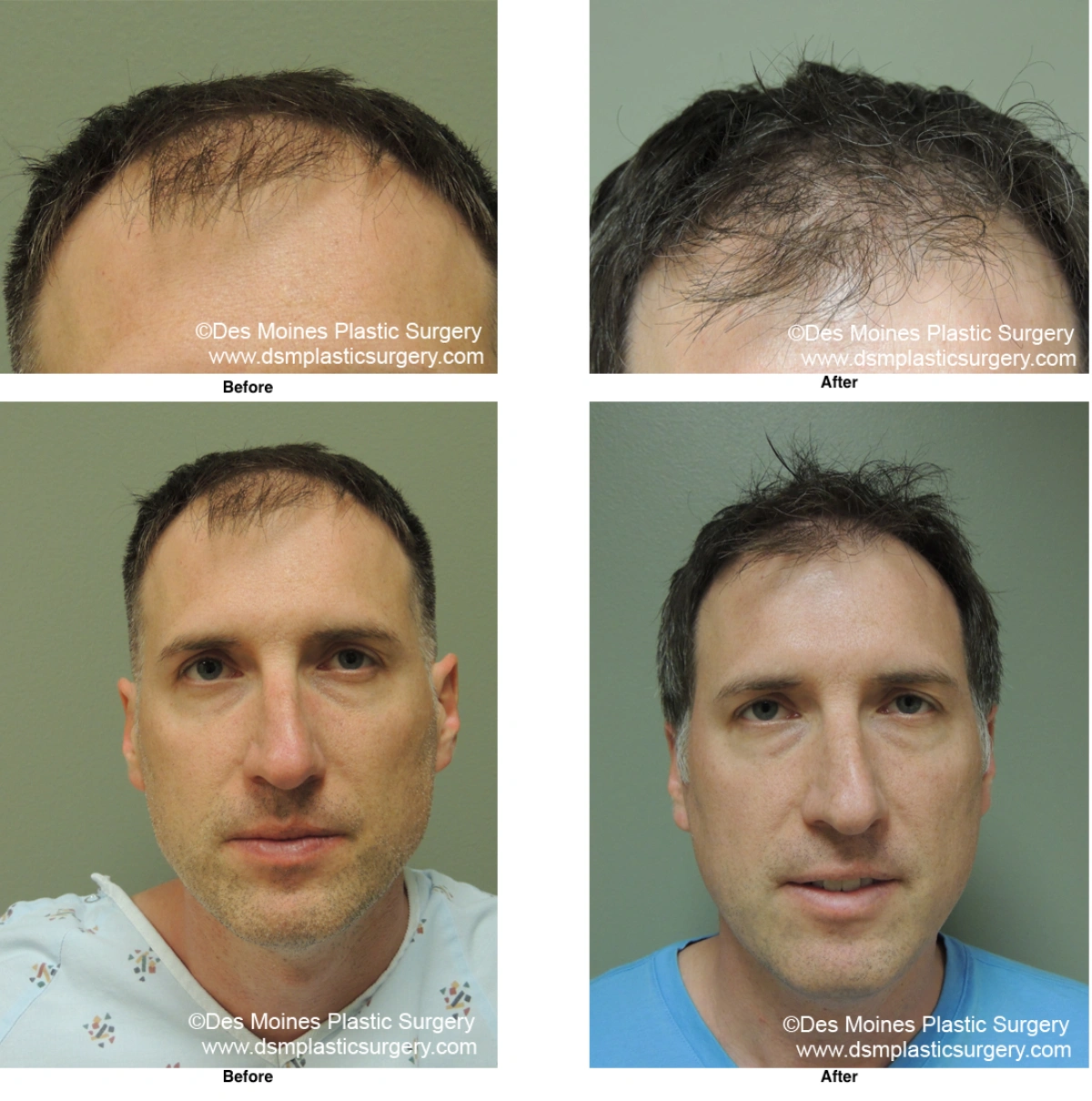 Neograft Hair Loss Replacement Before and After