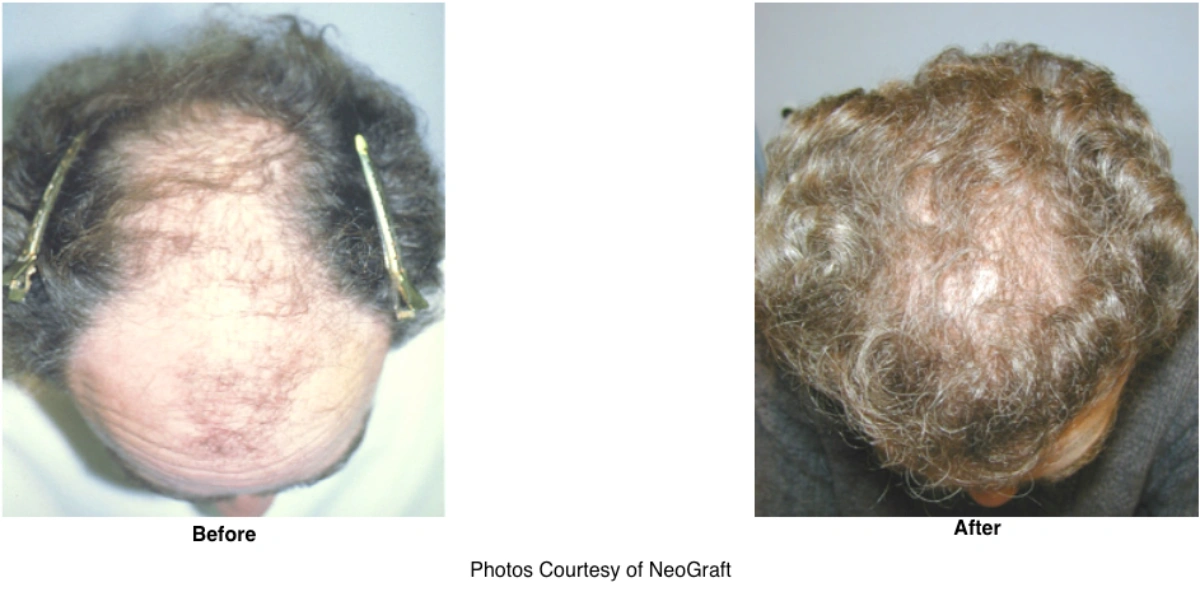 Neograft Hair Loss Replacement Before and After