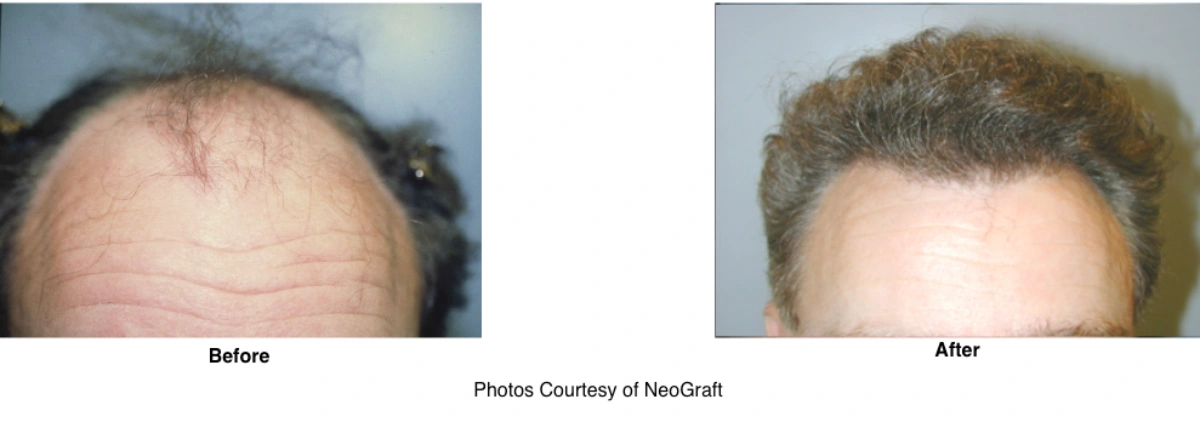 Neograft Hair Loss Replacement Before and After