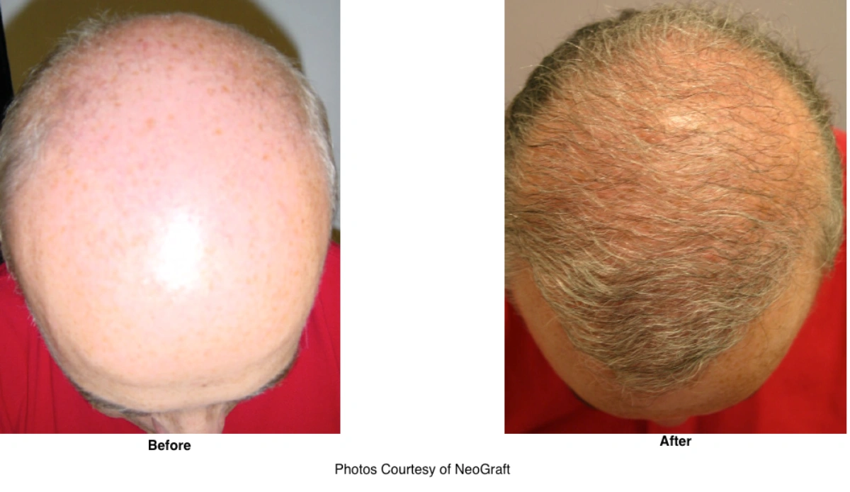 Neograft Hair Loss Replacement Before and After